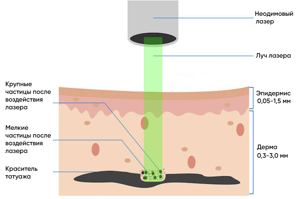 Воздействие неодимового лазера на кожу 